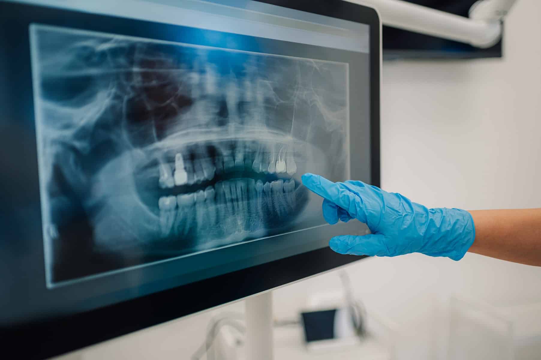 Dental implant teeth bridge in Sandy Springs, GA
