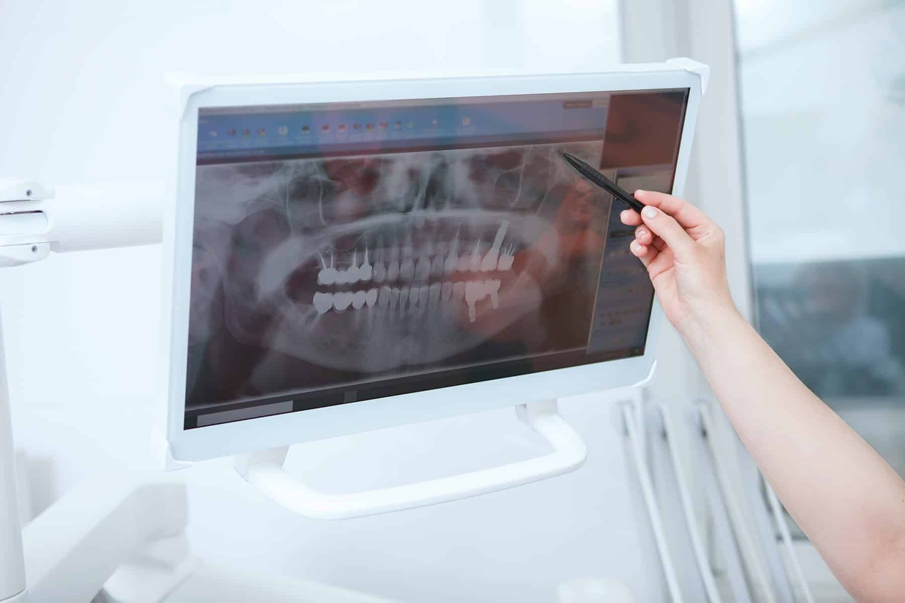 ExquisiteToothExtractions2-min Dental extractions in Sandy Springs, GA