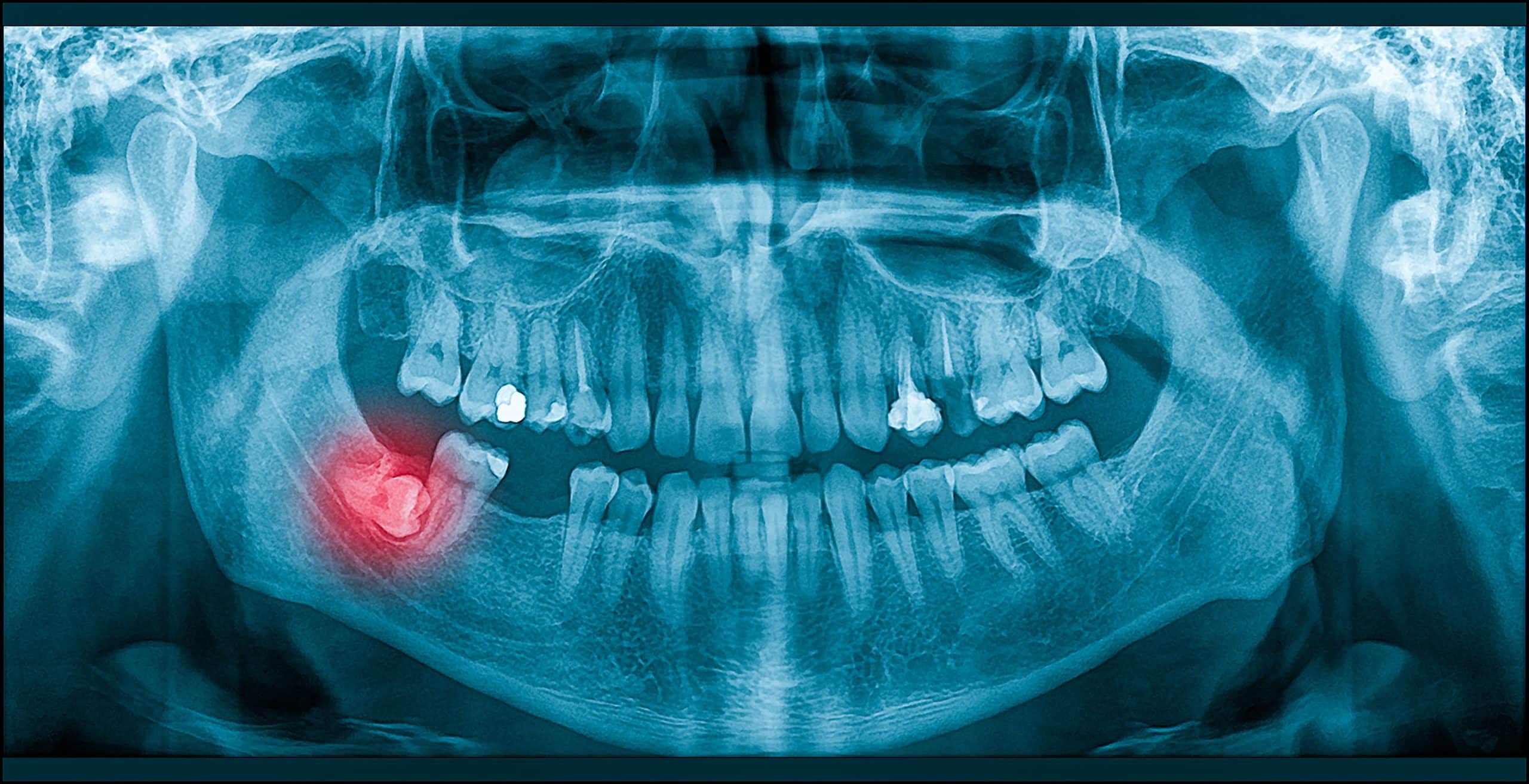 Wisdom tooth dentist in Sandy Springs, GA